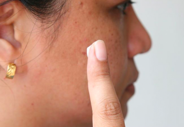 4 χρήσεις της οδοντόκρεμας στο δέρμα